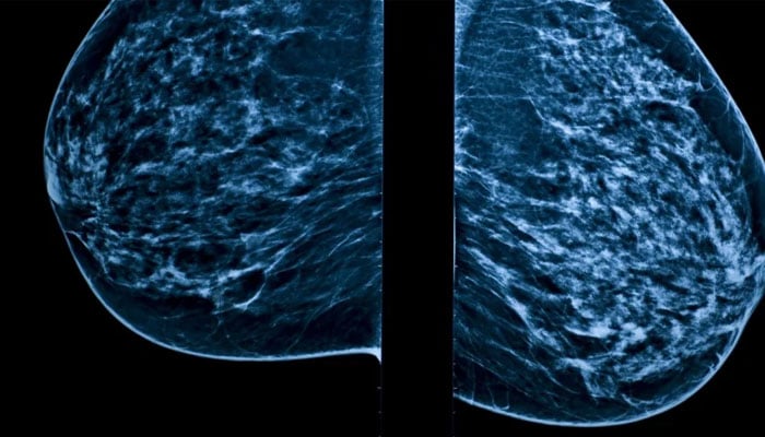 New study shows how breast cancer cells evade treatment