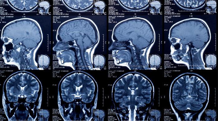 Over 42% world population have neurological disorders: WHO study
