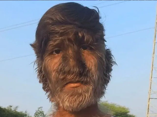 Indian teen with rare condition sets Guinness record for hairiest face