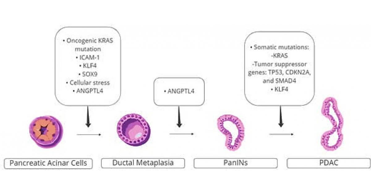 AI models might spot pancreatic cancer at an early stage and predict the deadly disease’s prognosis