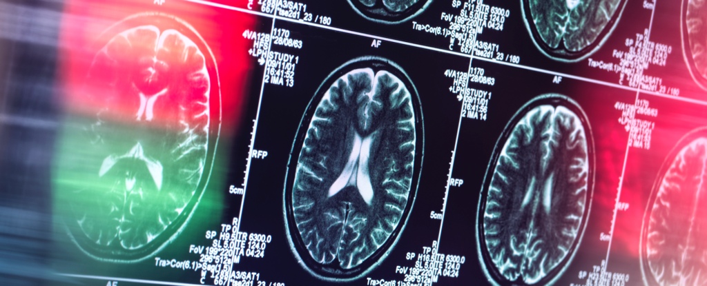 Alzheimer’s Might Not Actually Be a Brain Disease, Says Expert : ScienceAlert
