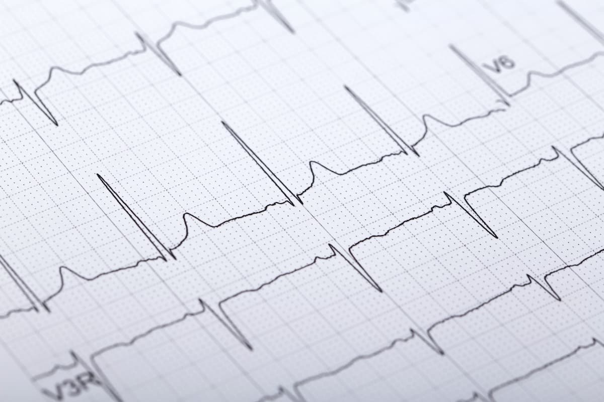 AI-Based Electrocardiogram Interpretation Detects LVSD in Muscular Dystrophy