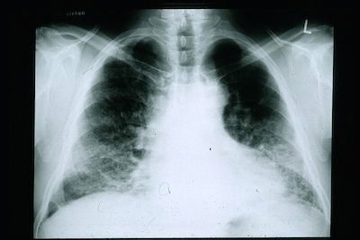 FDA Grants Orphan Drug Designation to Taladegib, Potential Idiopathic Pulmonary Fibrosis Treatment