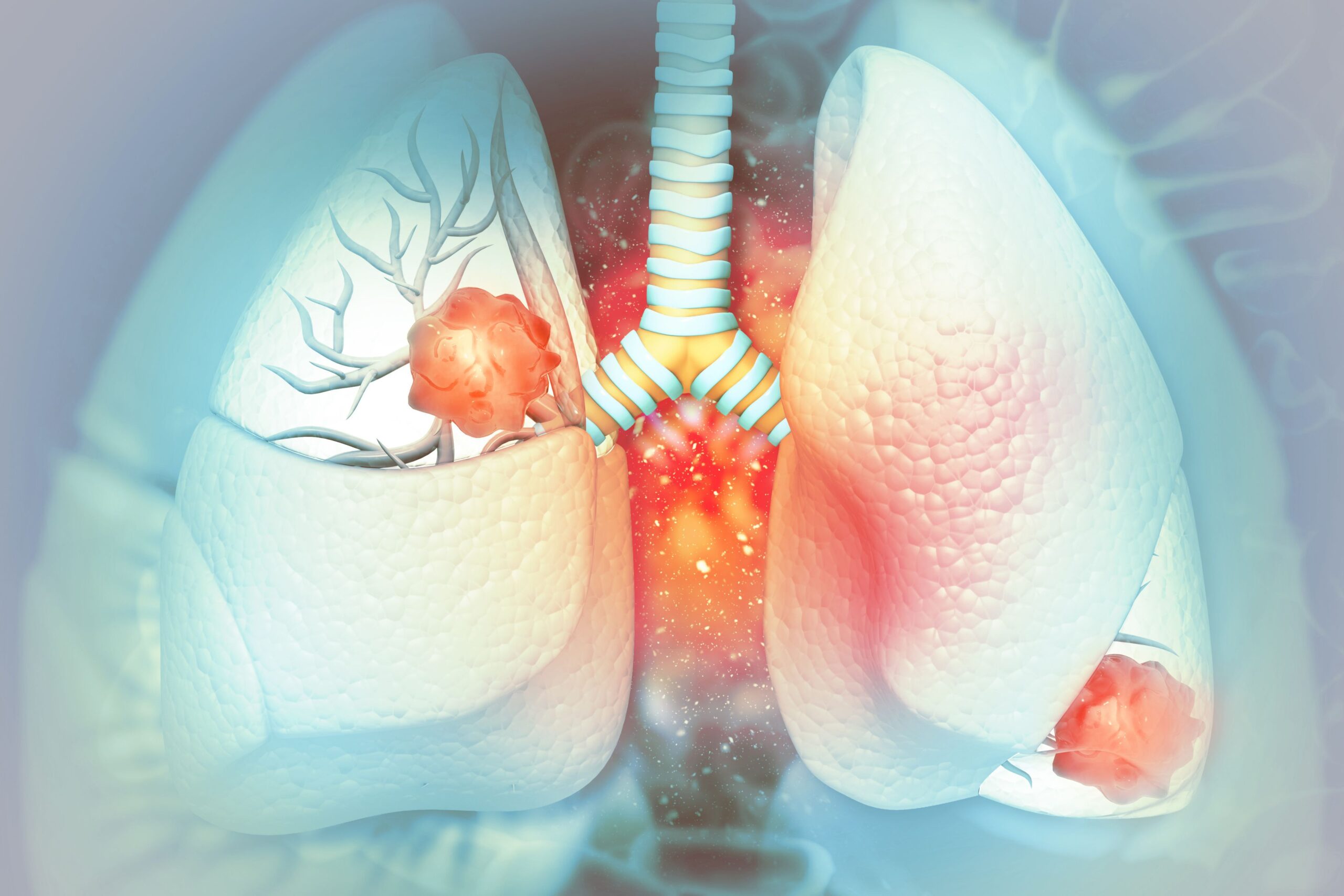 Baseline Steroid Use Linked to Poorer Outcomes in ICI-Treated Lung Cancer