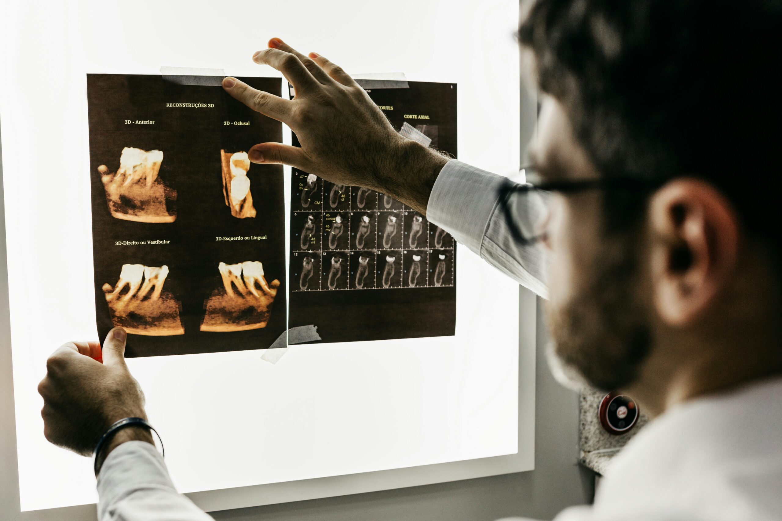 Gamma Knife Radiosurgery Targets Ovarian Brain Mets