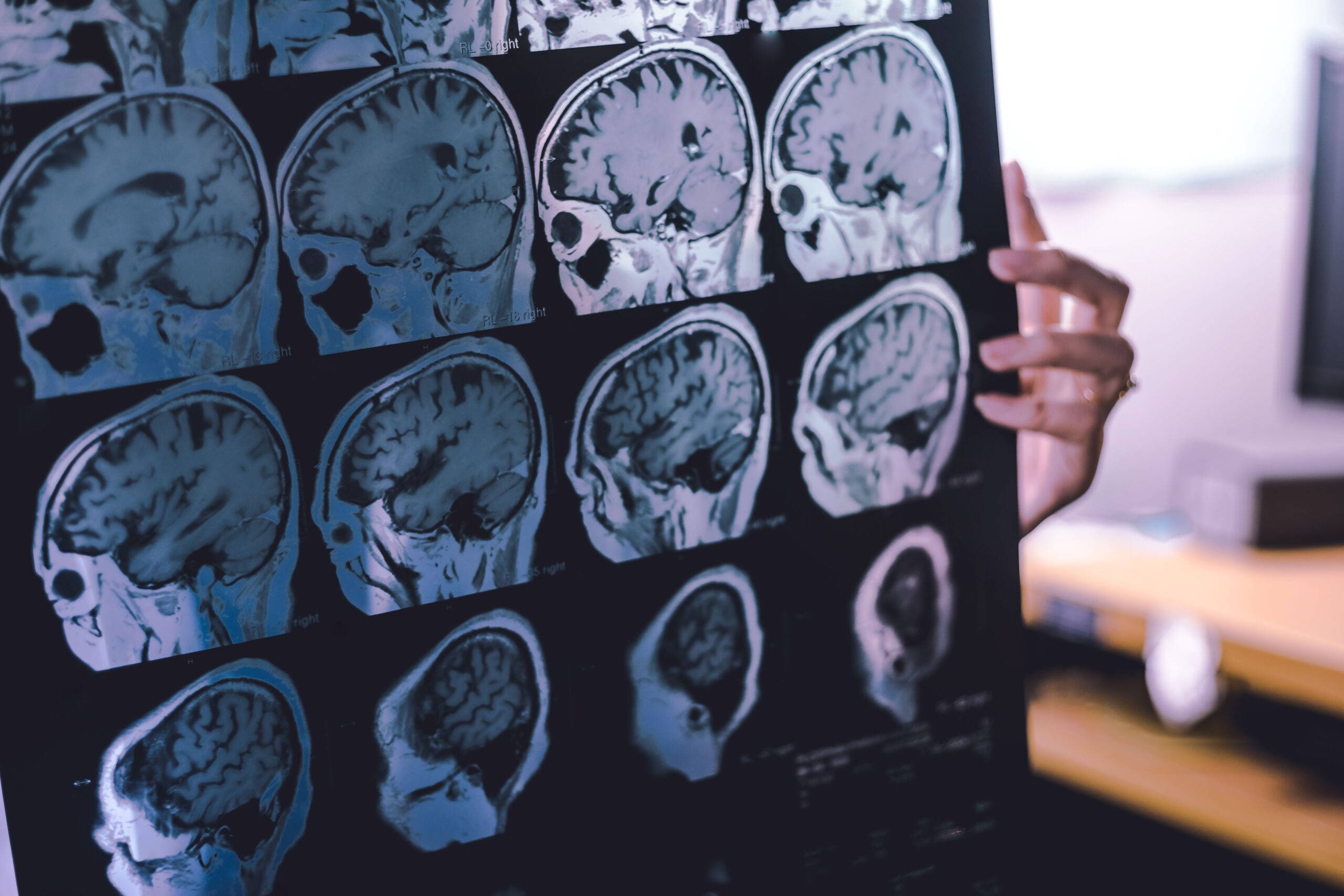 Cardiometabolic Diseases Linked With Increased Dementia RIsk For Younger, Female Patients
