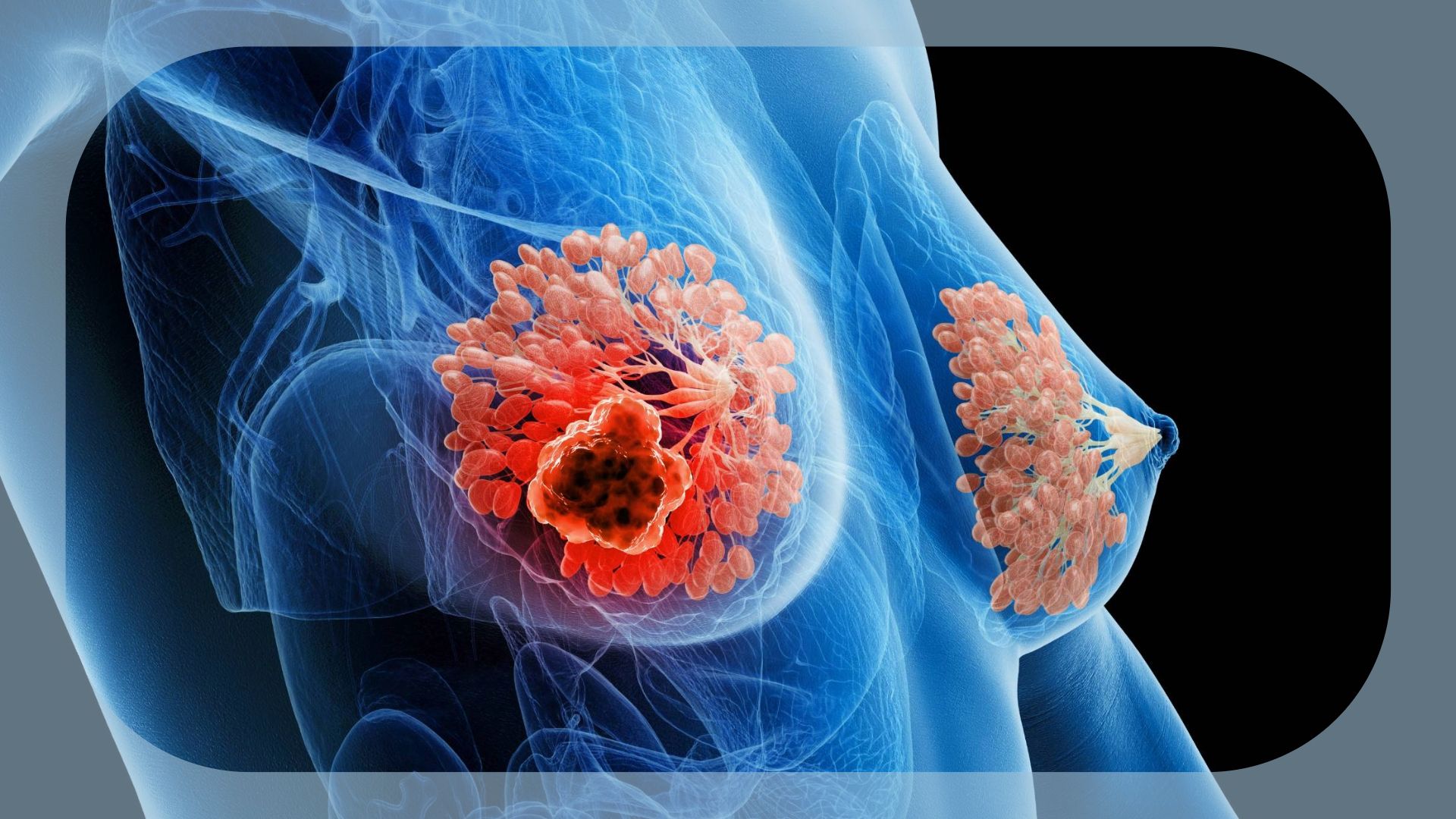 Patritumab Deruxtecan Shows CNS Efficacy in Metastatic Breast Cancer With Brain Metastases