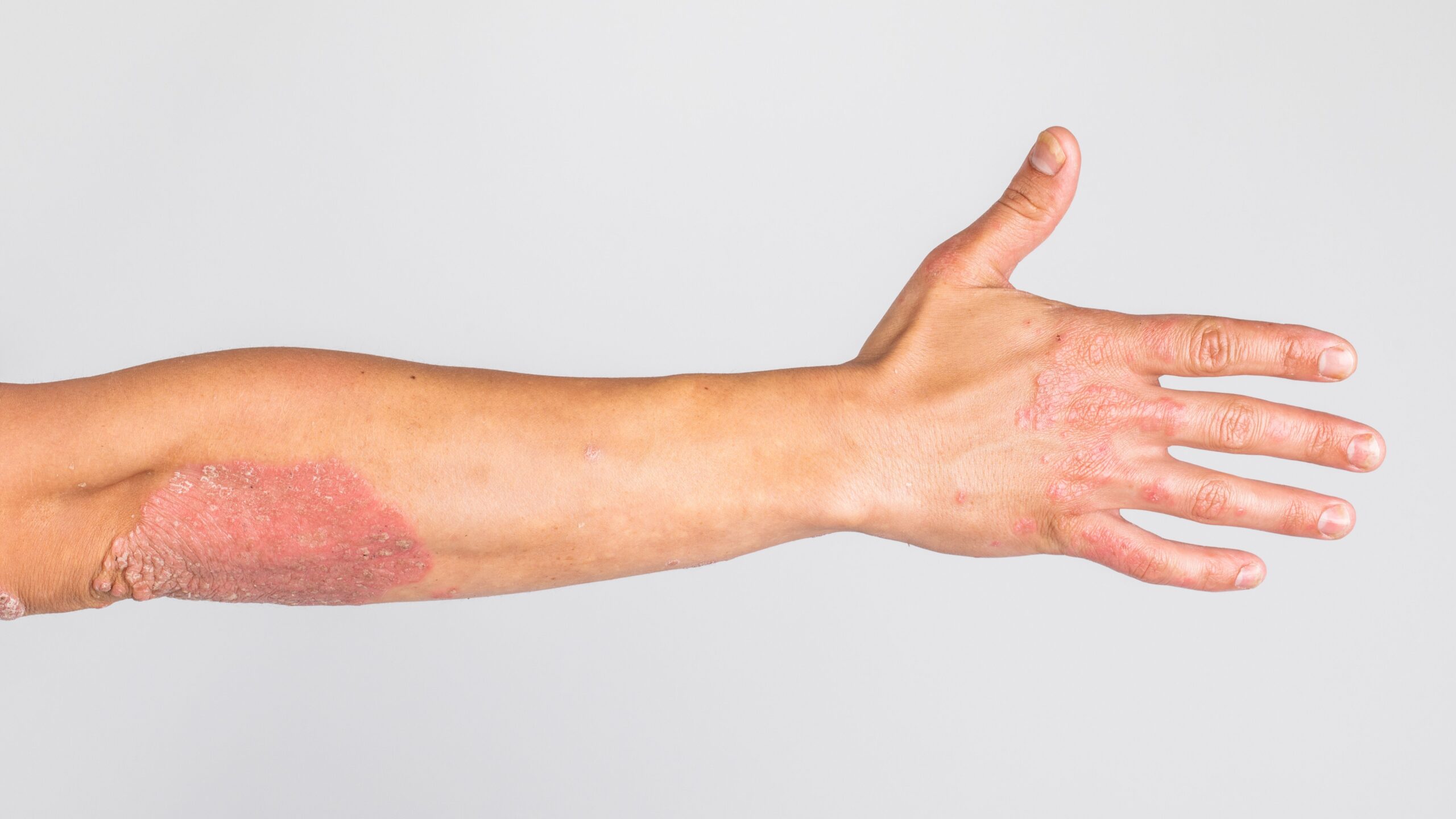 Risankizumab Found Effective in Patients With Moderate Plaque Psoriasis