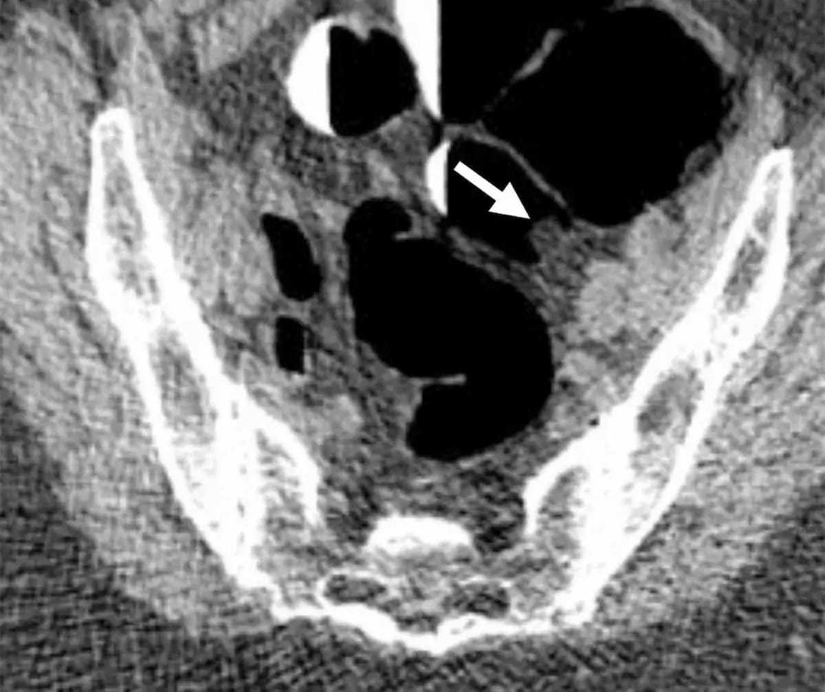 Twenty Years of CT Colonography for Colorectal Cancer Screening: What the Research Reveals