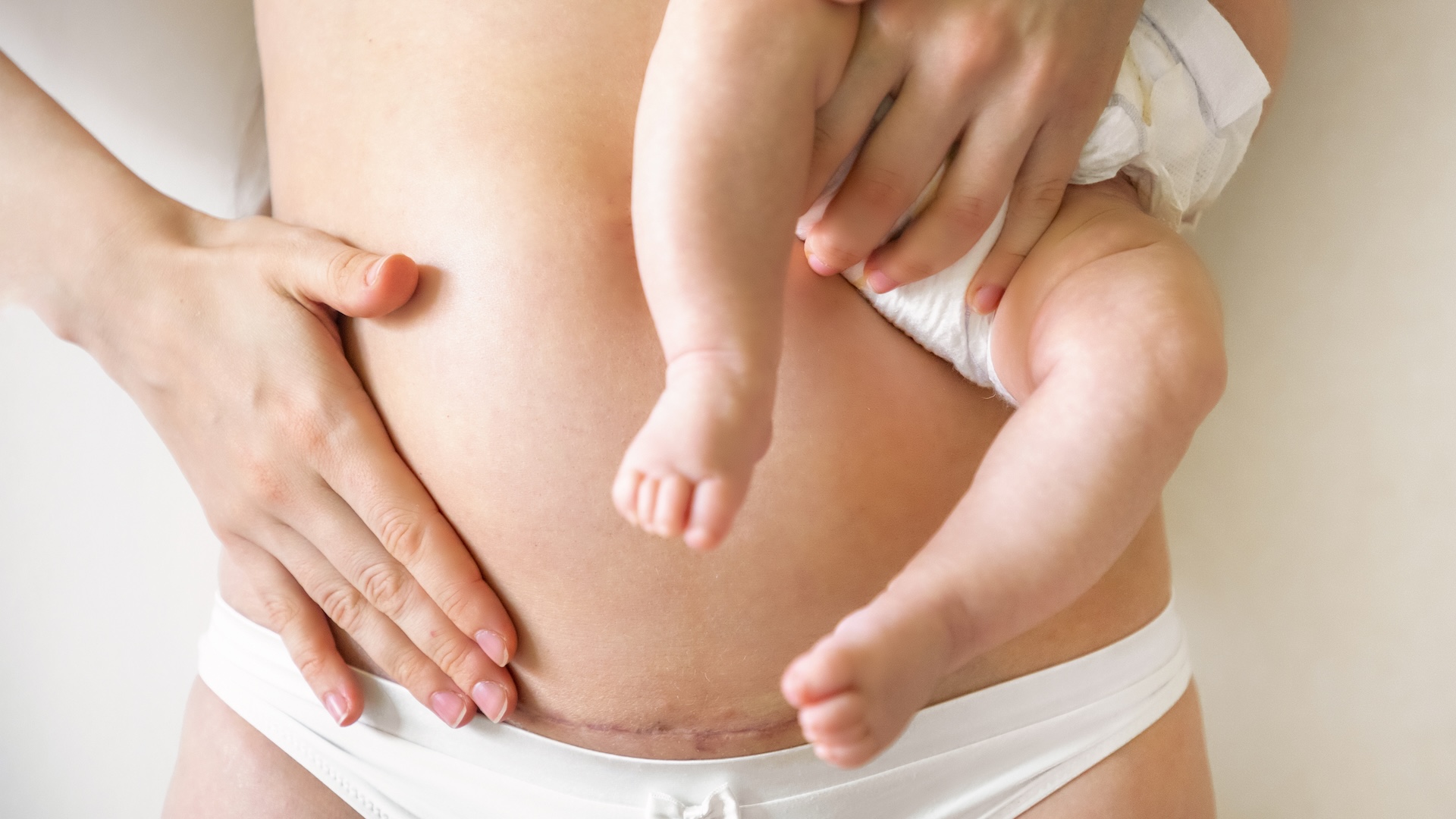 Planned C-sections linked to increased risk of childhood leukemia, study finds
