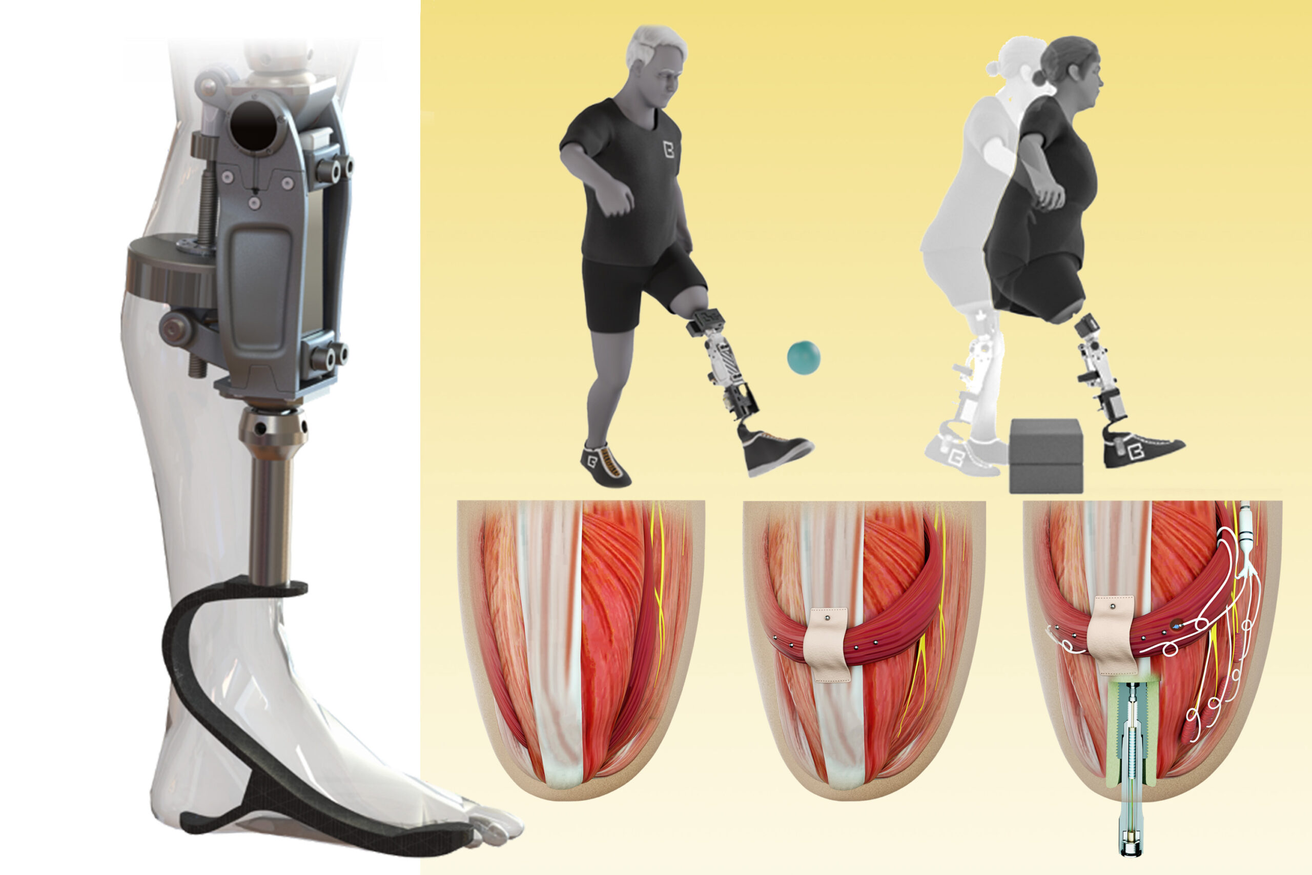 A bionic knee integrated into tissue can restore natural movement | MIT News