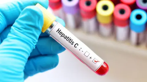 Getty Images A test tube of blood has a sticker on it saying Hepatitis C held by a hand wearing a blue glove. Test tubes with colourful lids can be seen in the background, blurred.
