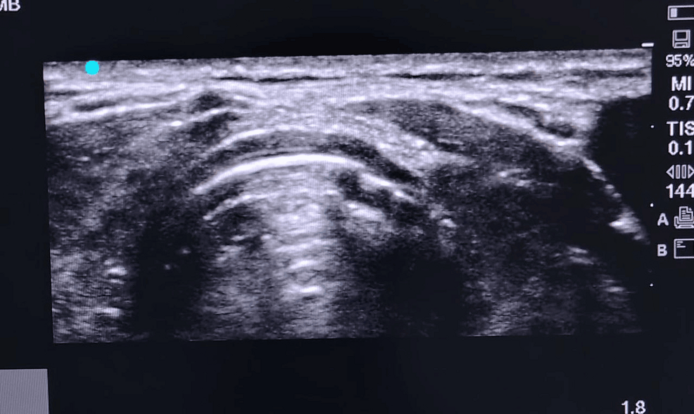 A Prospective Observational Study to Assess the Diagnostic Accuracy of Suprasternal Versus Subxiphoid Ultrasonography for Endotracheal Intubation in Patients Undergoing Elective Surgery