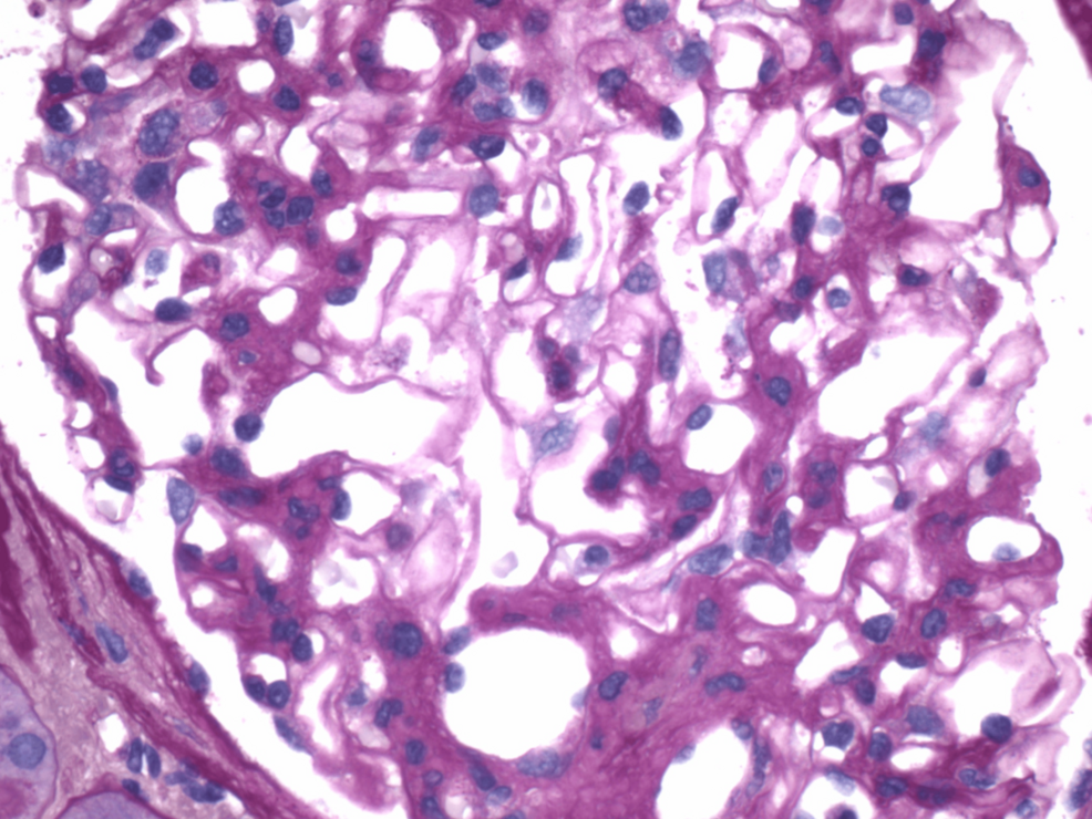 Idiopathic Fibrillary Glomerulonephritis: A Case Report Highlighting Diagnostic and Management Challenges