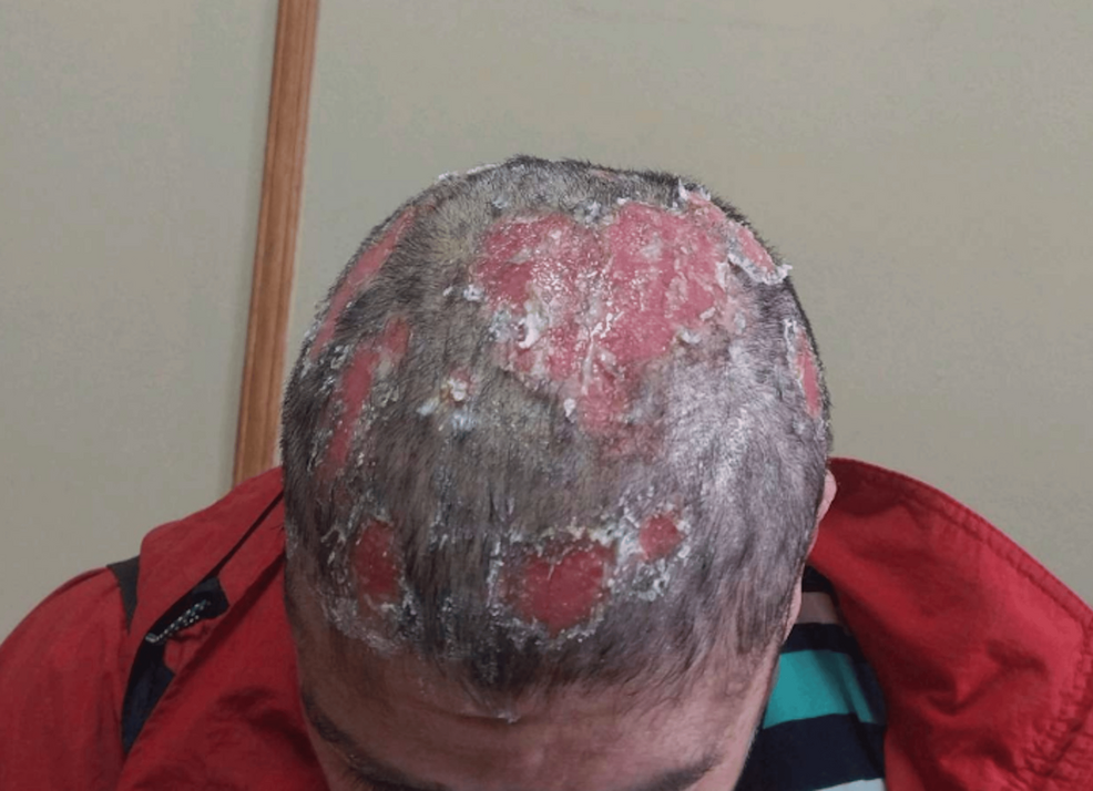A Case Report of Pemphigus Vulgaris Initially Misdiagnosed as Tinea Capitis: Infectious Consequences of Diagnostic Delay in a Patient Treated With Rituximab