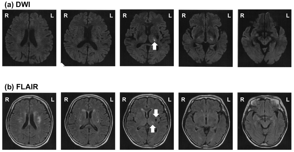 Evaluating Postural Control Functions With a Focus on Vestibular Sensation in Thalamic Astasia: A Case Report