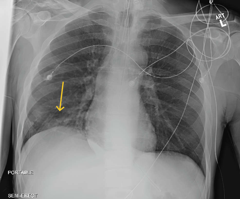 Xylazine Withdrawal: A Case Report From the Intensive Care Unit to the Medical Ward