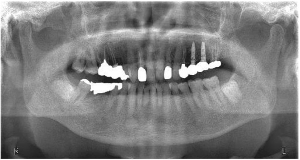 Focal Myositis of the Masseter Muscle Masquerading as Temporomandibular Disorder: Diagnostic Challenges and Management