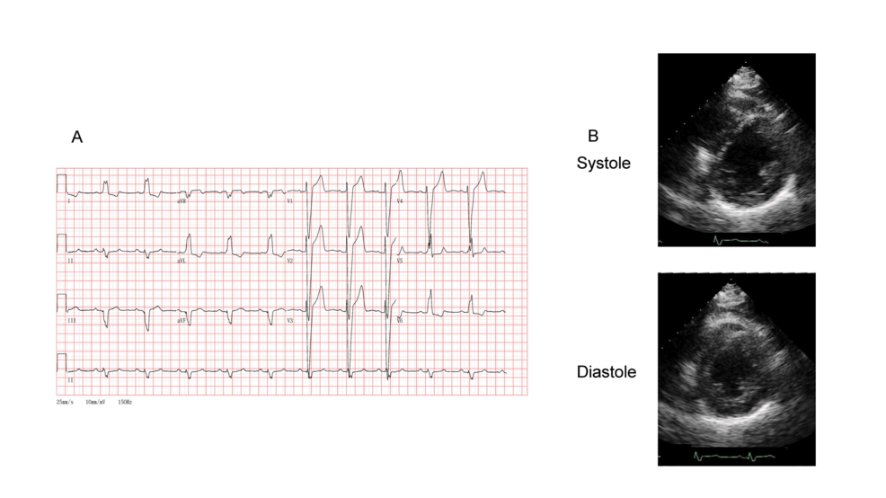 A Challenging Case of Wild-Type Transthyretin Amyloidosis (ATTR) Amyloidosis Treated With Cardiac Resynchronization Therapy