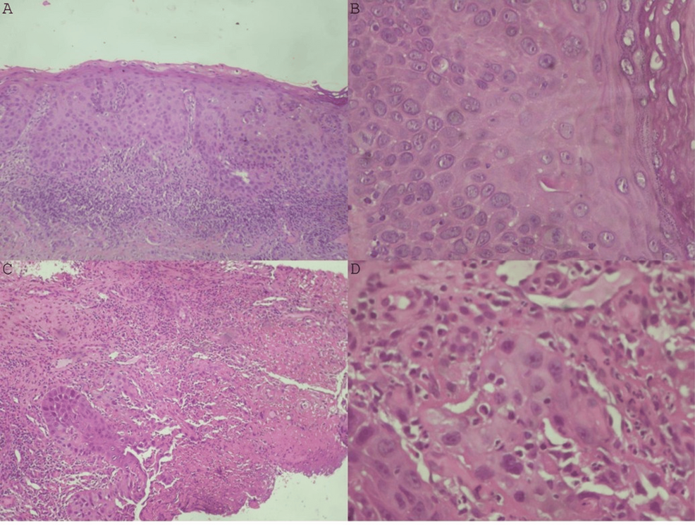 Rapid Progression of Oral Leukoplakia to Oral Squamous Cell Carcinoma in an HIV-Positive Patient: A Case Report
