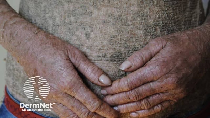 Ichthyosis Score Reliable in Skin of Color