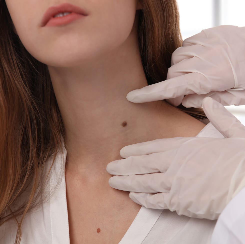 doctor dermatologist examines birthmark of patient close up. checking benign moles. laser skin tags removal