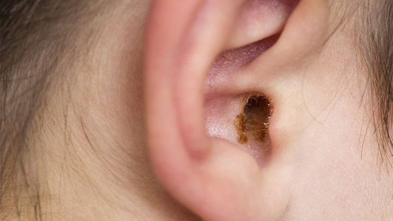 Earwax Secretions May Help Detect Parkinson’s Disease