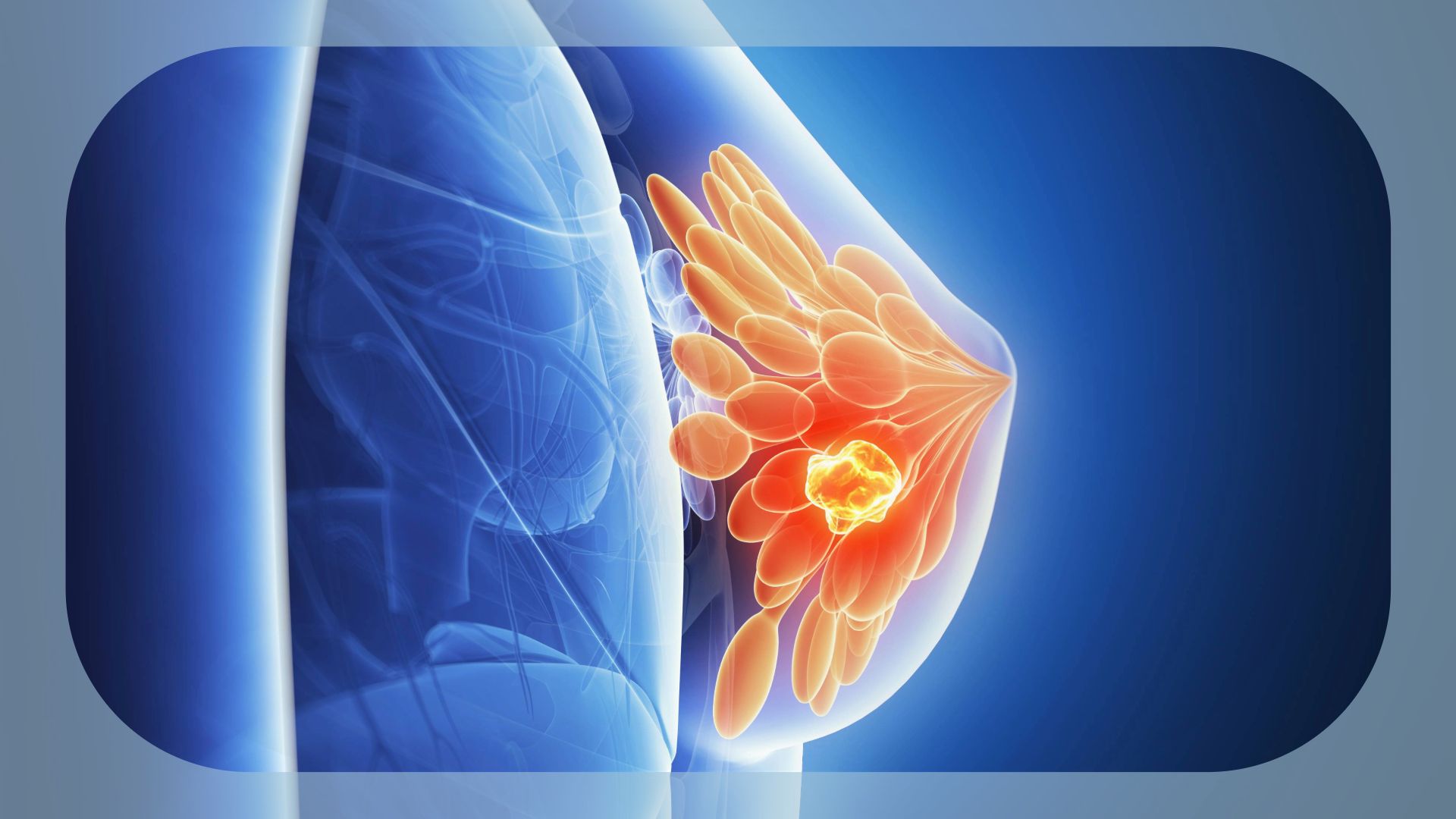 TQB2930 Plus Chemo Drives Responses in Pretreated HER2+ Metastatic Breast Cancer