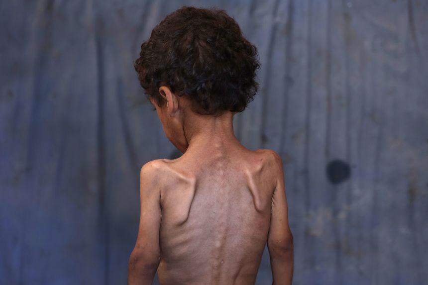 Yazan, a malnourished 2-year-old Palestinian boy, stands with his back turned in his family's damaged home in the Al-Shati refugee camp on July 23.