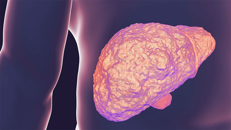 Steatotic Liver Disease Prevalent in At-Risk Adults