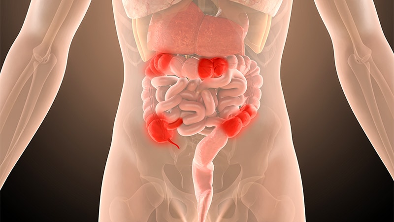 Disease Location Affects Outcomes in Paediatric Crohn’s
