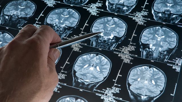 Brain Stimulation May Improve Neuron Health in Alzheimer’s
