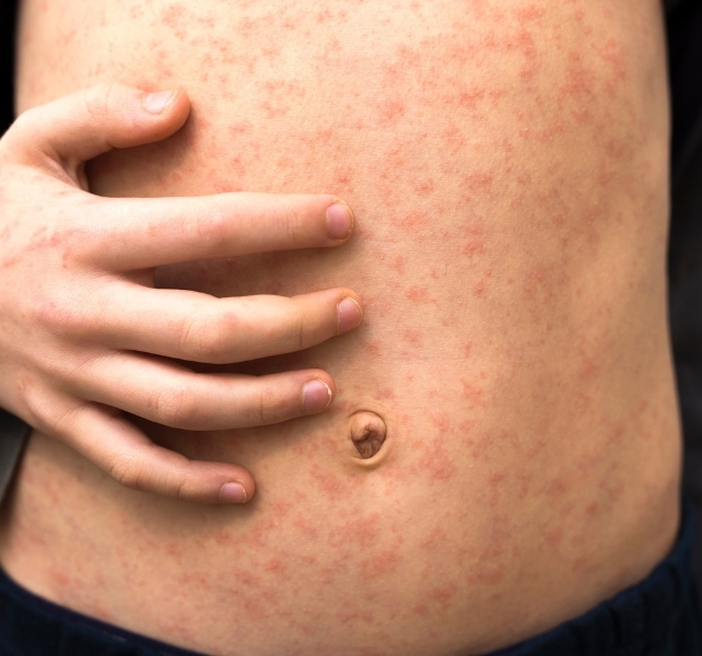 measles rash