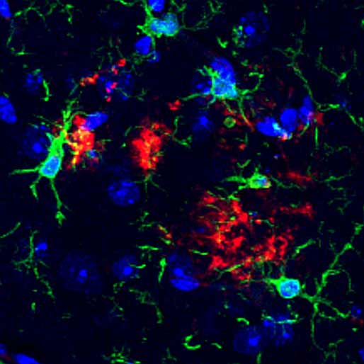 A fluorescent microscope image shows blue cell nuclei, green branching structures called microglia), and red clusters that are amyloid beta plaques.