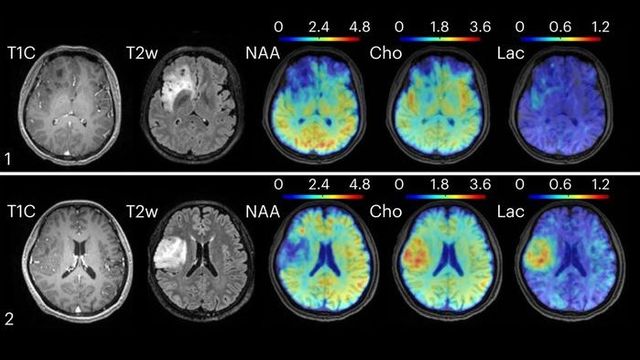 MRI Technique Detects Brain Disease by Mapping Metabolism