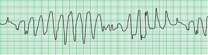 photo of Ventricular tachycardia, ecg
