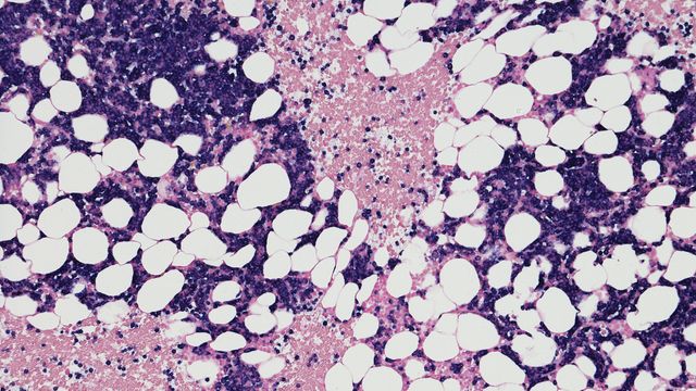 RNA Blood Test Detects Early Colon Cancer with 95% Accuracy