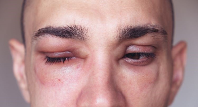 FDA hereditary angioedema