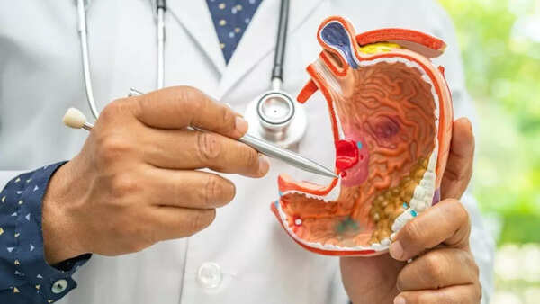 Stomach cancer (3)