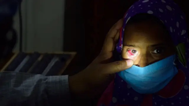 Conjunctivitis Outbreak Sweeps Malakand, Over 1,600 Cases Reported in Batkhela