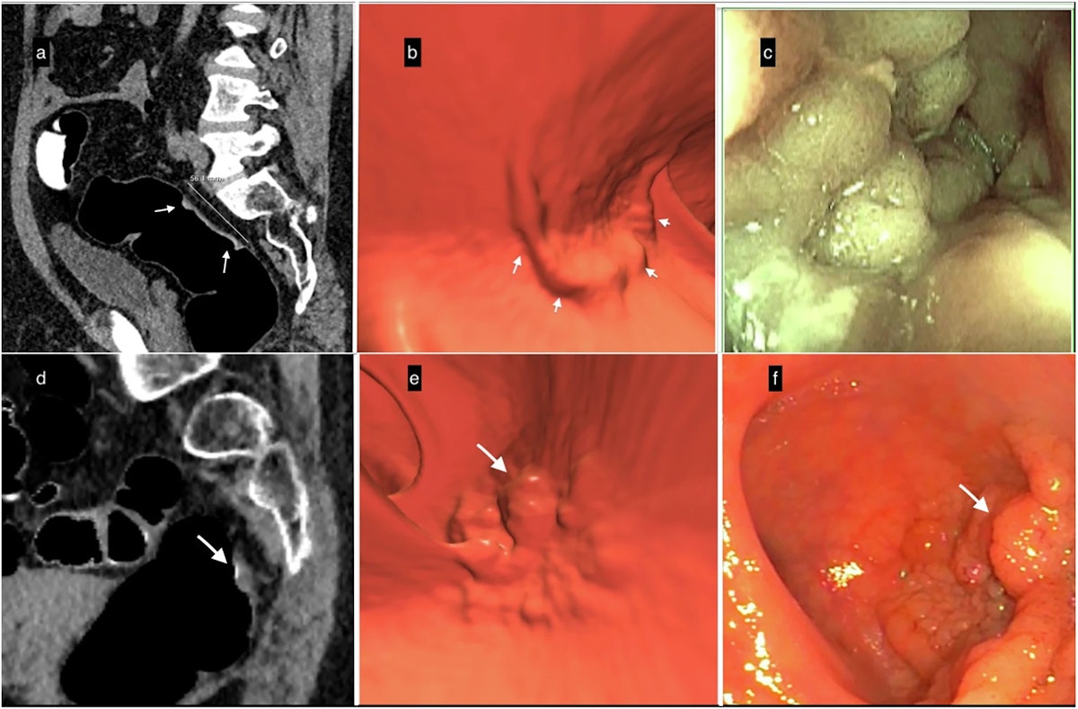 French experts reflect on 30 years of CT colonography