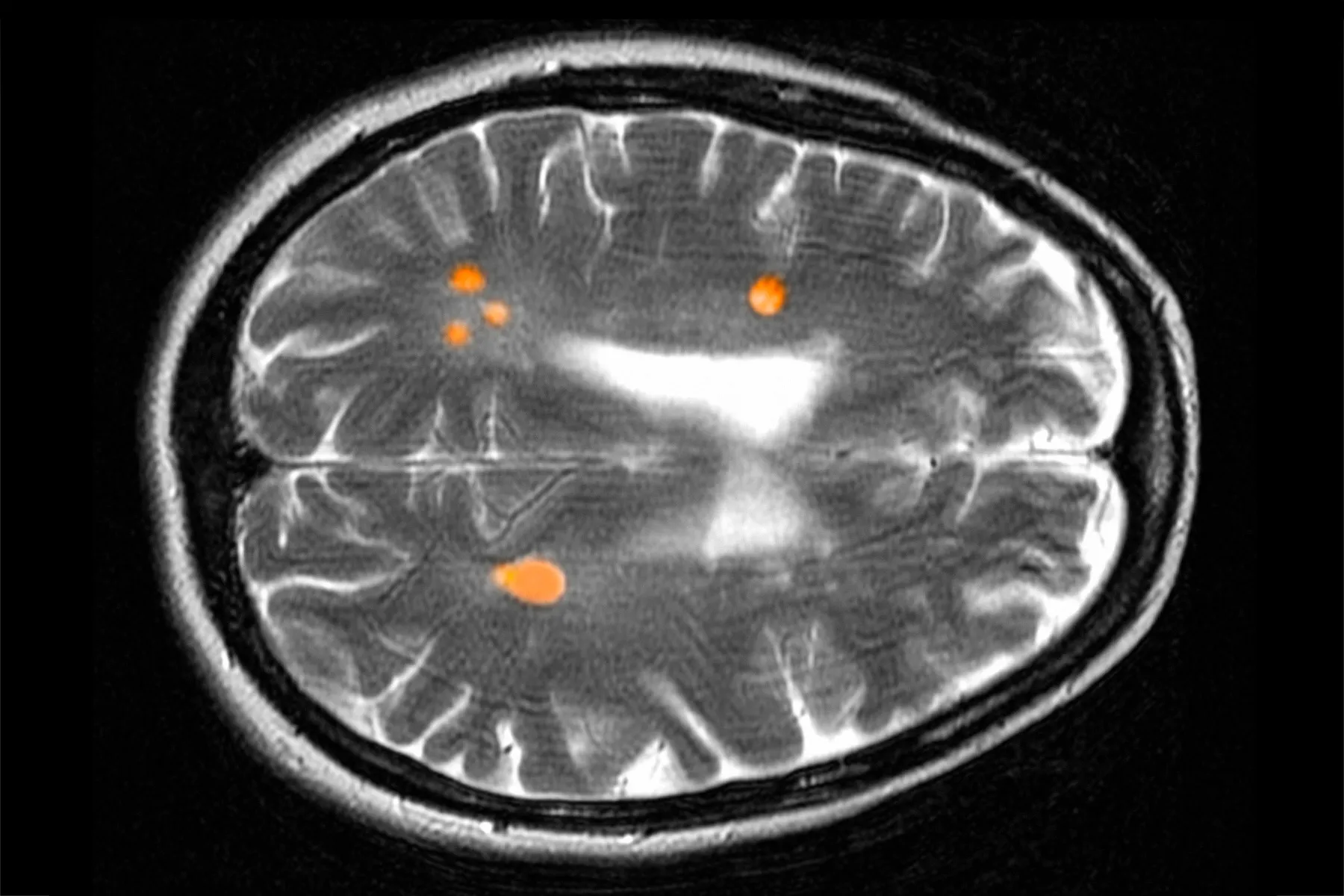 The Push to Diagnose MS Years Before Symptoms Start