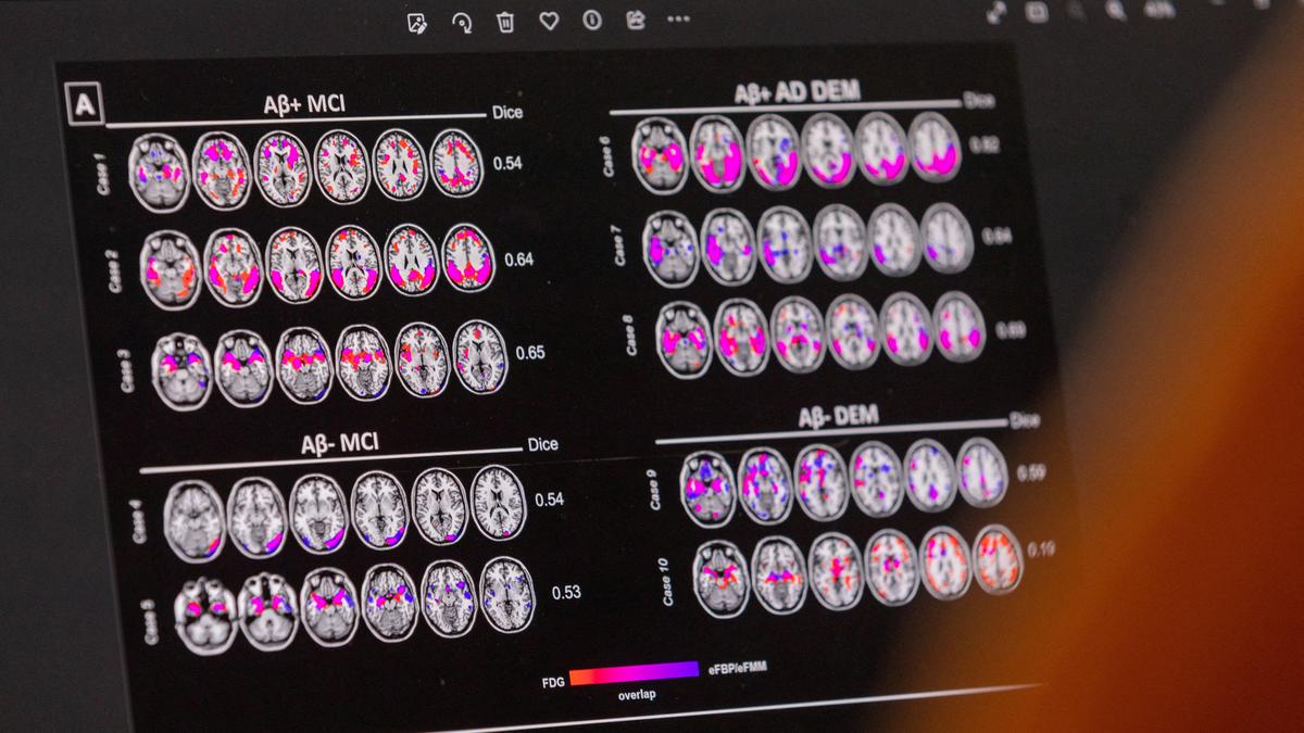 Lithium deficiency could lead to Alzheimer’s, study suggests