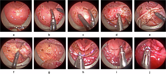 TEMSET-24K: Densely Annotated Dataset for Indexing Multipart Endoscopic Videos using Surgical Timeline Segmentation