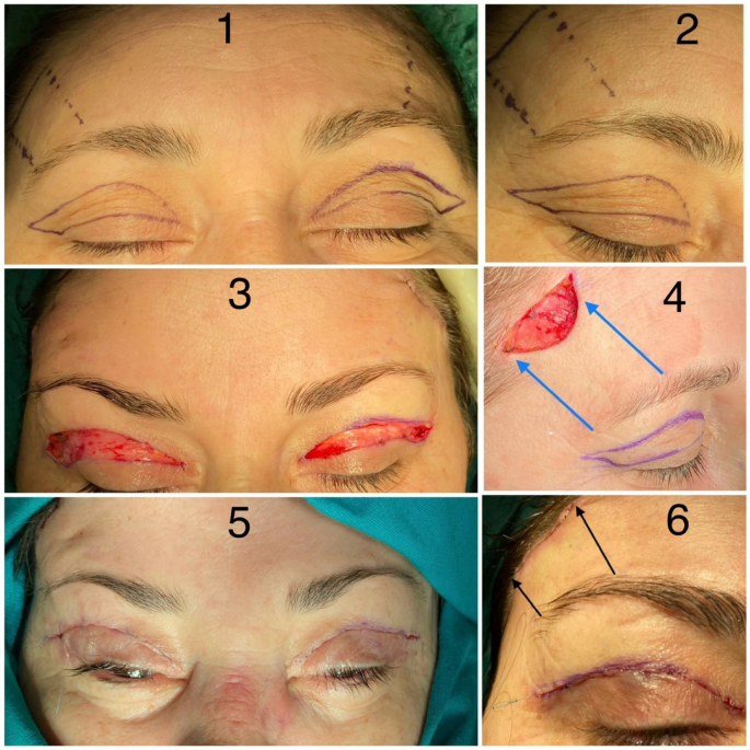 Lateral pretrichial subcutaneous brow lift with upper eyelid blepharoplasty