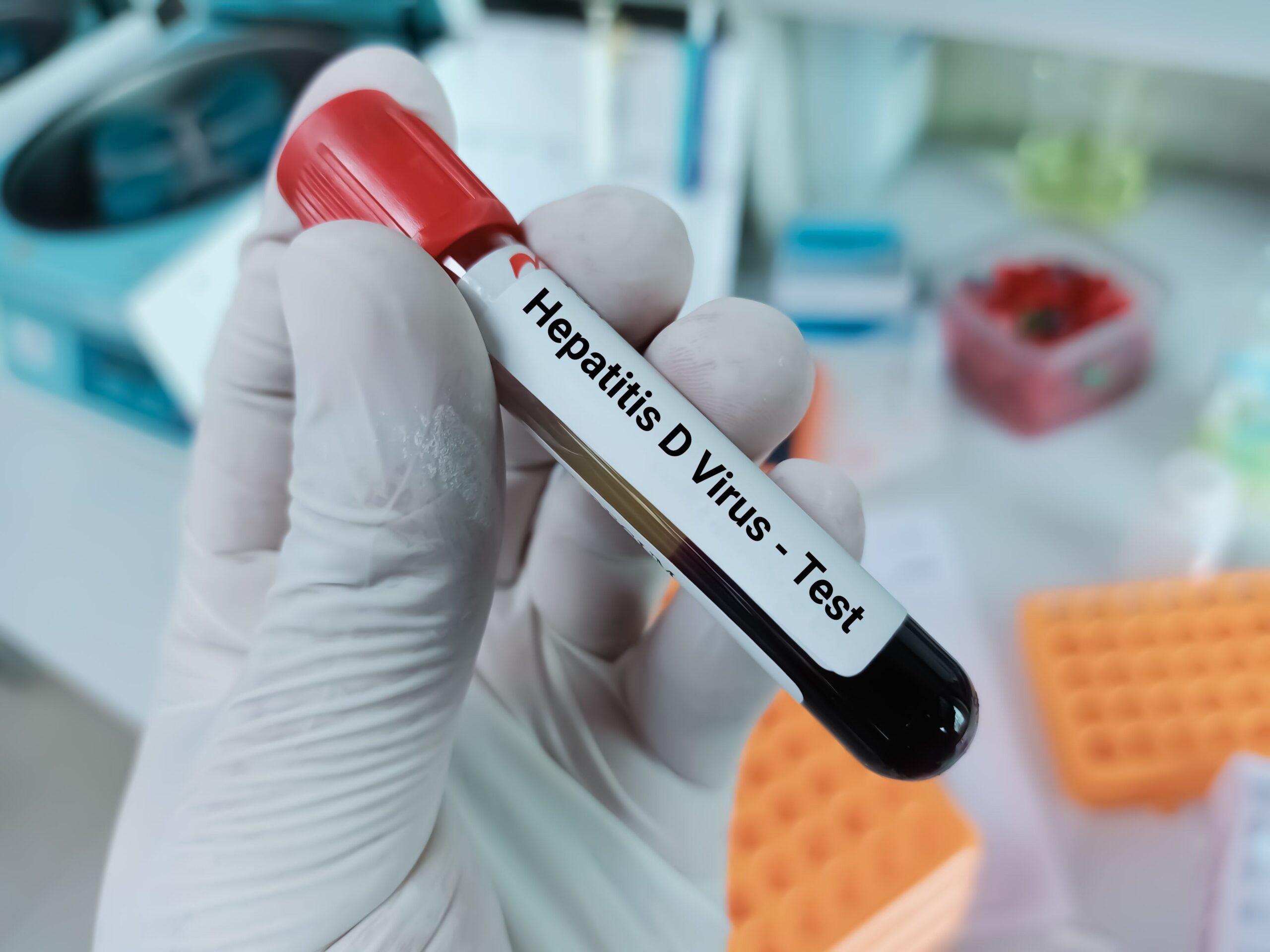 Hepatitis D Reclassified as Carcinogenic, According to WHO