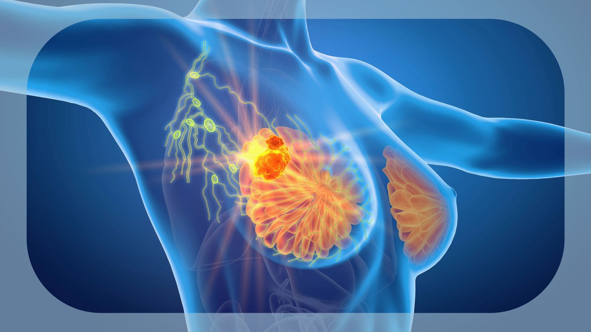 Real-World Outcomes Support Use of First-Line Palbociclib Plus ET in HR+/HER2– Advanced Breast Cancer