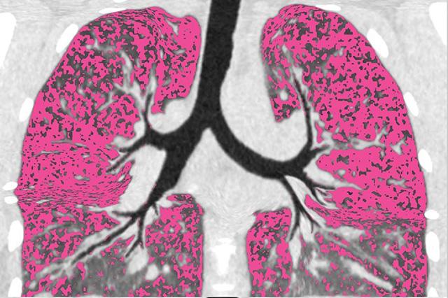 Going in for a close look at lung infections – UW Medicine