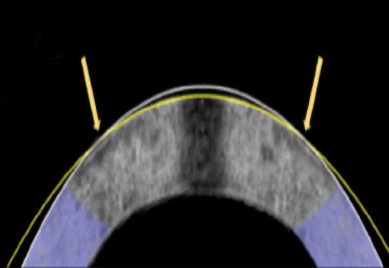 Electromechanical Reshaping Technique Successfully Flattened Rabbit Cornea