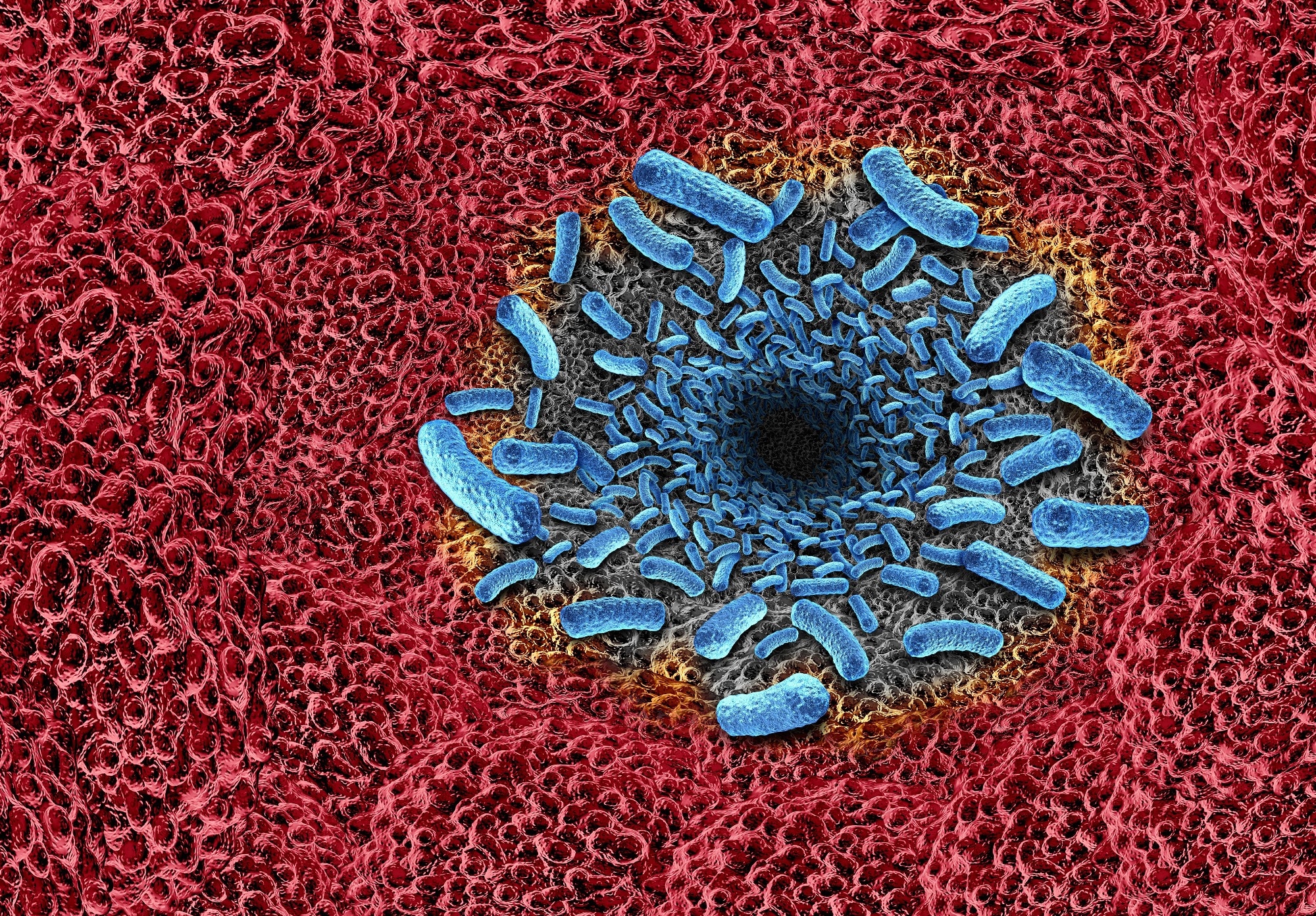 The “Flesh-Eating” Bacteria Behind Coastal Infections
